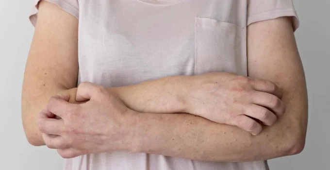 Sarna Humana em Minas: SES Divulga Orientações e Reforça Monitoramento de Surtos em Cidades Mineiras