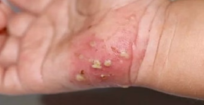 MG: Governo orienta medidas contra surto de sarna humana e reforça vigilância em saúde