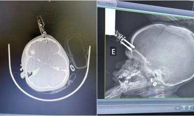 Tragédia Evitada em Divinópolis: Menina de 1 Ano Sofre Grave Ferimento na Testa Após Queda com Carregador