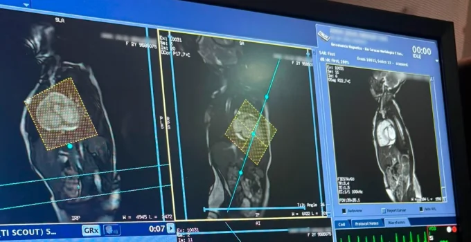 Hospital Márcio Cunha Revoluciona Cardiologia Pediátrica no Vale do Aço com Primeira Ressonância Cardíaca Infantil