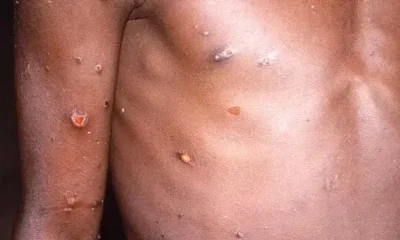 Mpox em BH: Três Casos em Dois Meses Levantam Alerta para Risco de Surto Pós-Carnaval