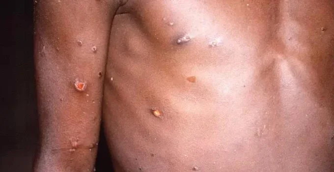 Mpox em BH: Três Casos em Dois Meses Levantam Alerta para Risco de Surto Pós-Carnaval