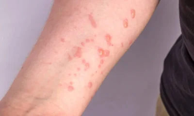 Mpox em BH: Estado de Minas confirma três casos em 2026, dois deles na capital