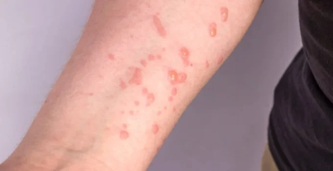 Mpox em BH: Estado de Minas confirma três casos em 2026, dois deles na capital