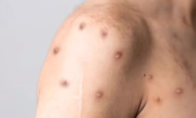 Mpox em Minas Gerais: Número de Casos Confirmados Sobe para 13, Grande BH Concentra Registros