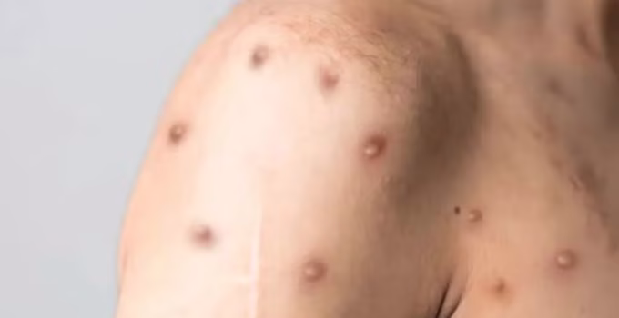 Mpox em Minas Gerais: Número de Casos Confirmados Sobe para 13, Grande BH Concentra Registros