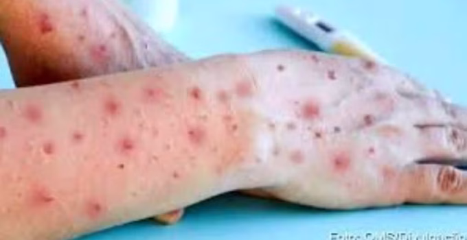 Mpox: Manhuaçu registra primeiro caso da doença em 2026 e Minas Gerais soma 17 ocorrências