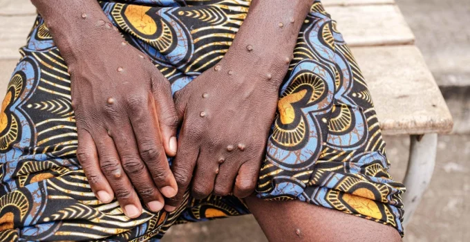 Mpox: Belo Horizonte e Manhuaçu registram novos casos e total no estado sobe para 17